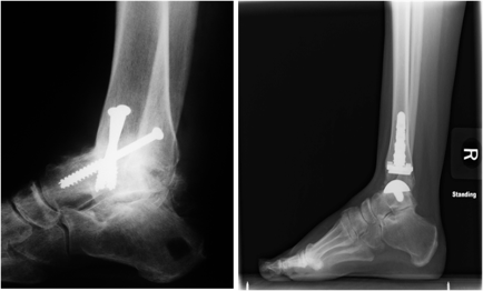 The image on the right is an X-ray of an ankle fusion (using three metal screws that show up as bright white). The shin and the ankle have fused together and the space between them is no longer visible. The image on the left is an X-ray ofan ankle replacement (which shows up as bright white).Credit: American Orthopaedic Foot and Ankle Society (AOFAS)—used with permission.